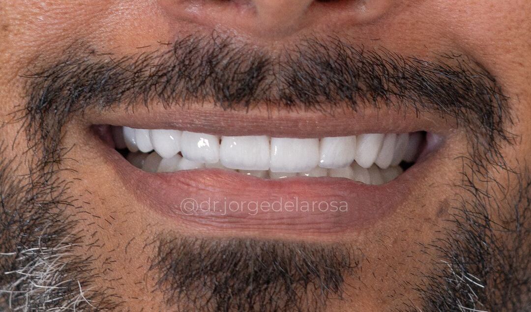 Después