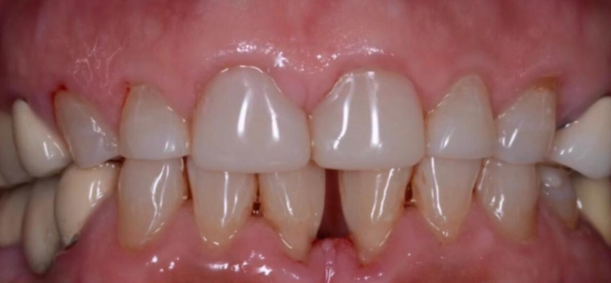 Antes